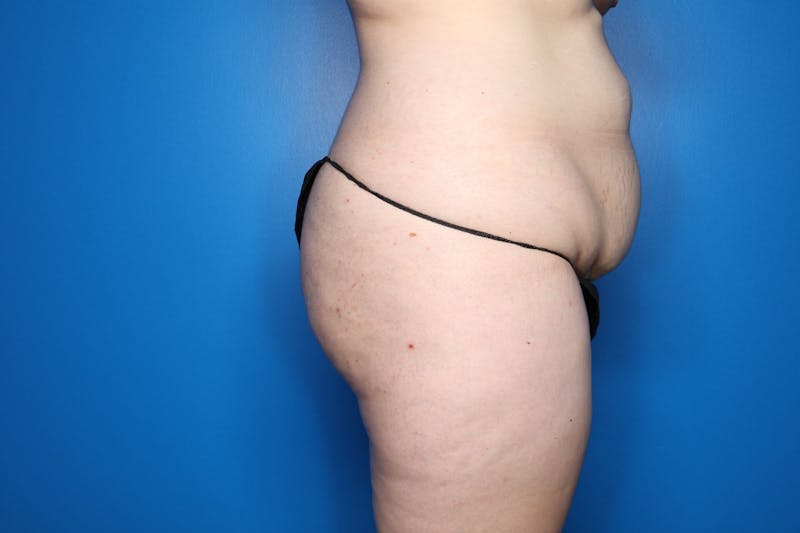 Tummy Tuck Before & After Gallery - Patient 146783 - Image 5