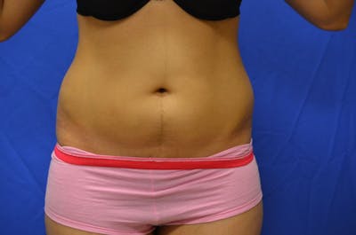 Liposuction Before & After Gallery - Patient 116564 - Image 1