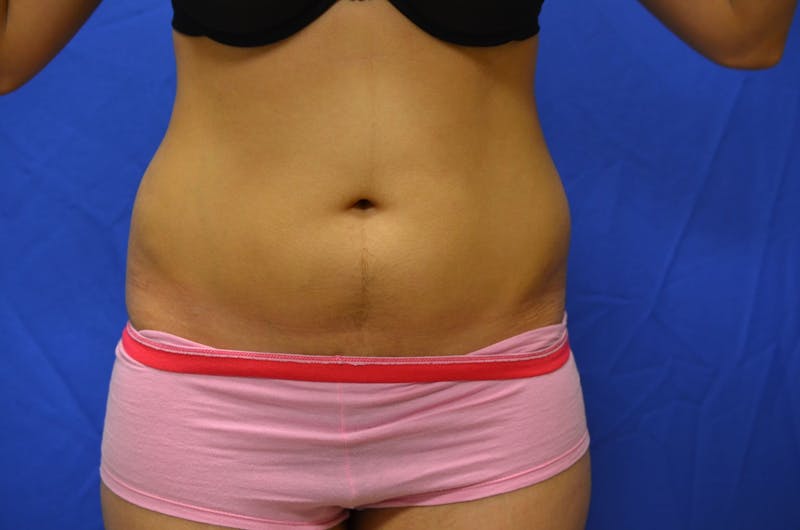 Liposuction Before & After Gallery - Patient 116564 - Image 1