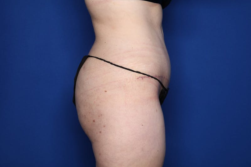 Tummy Tuck Before & After Gallery - Patient 146783 - Image 6