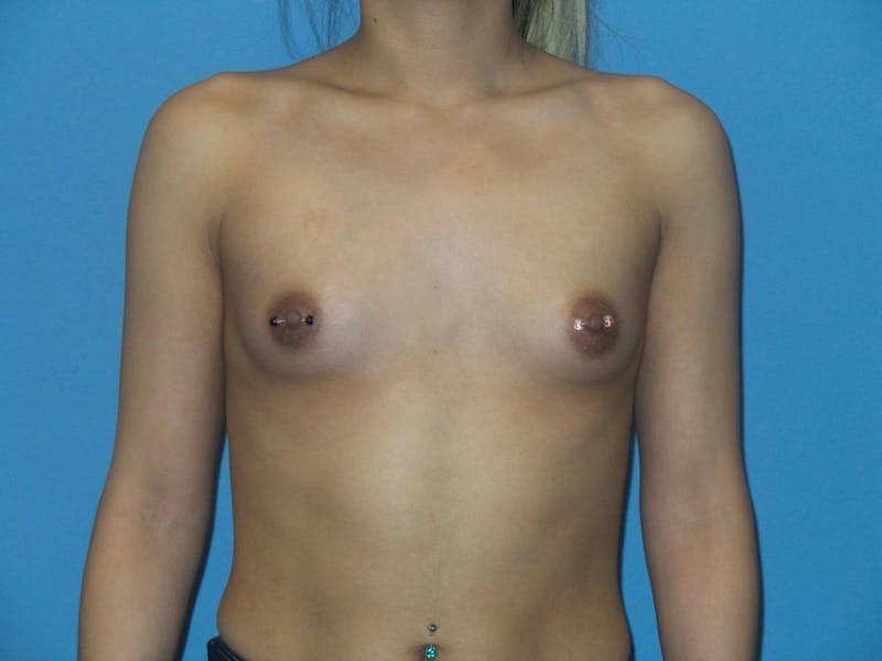 Breast Augmentation Before & After Gallery - Patient 123526 - Image 1