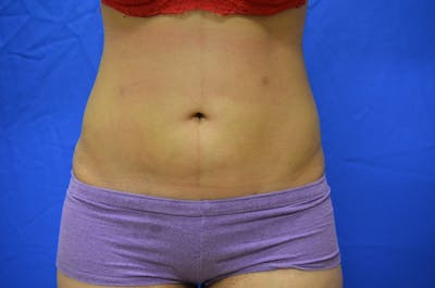 Liposuction Before & After Gallery - Patient 116564 - Image 2