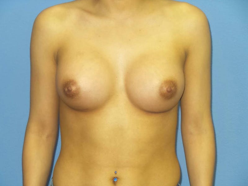 Breast Augmentation Before & After Gallery - Patient 123526 - Image 2