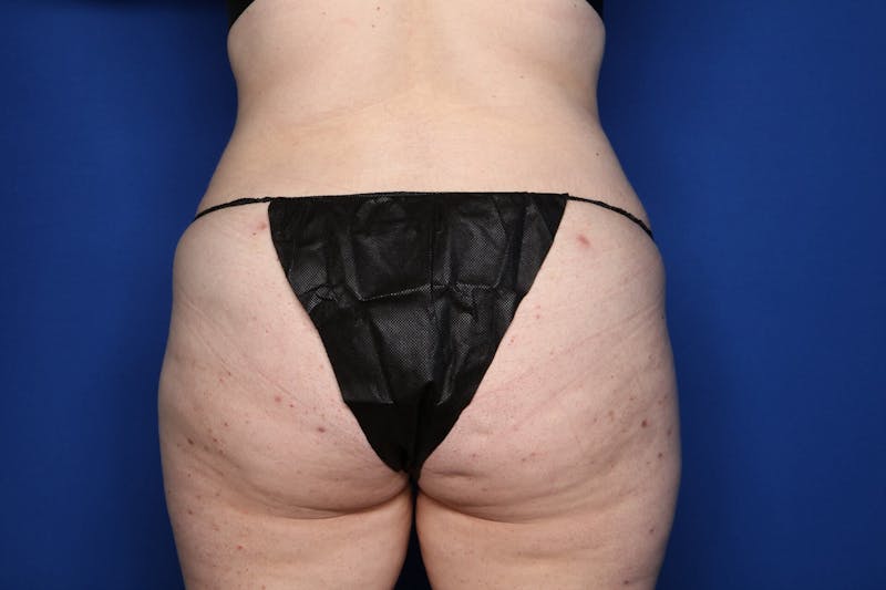 Tummy Tuck Before & After Gallery - Patient 146783 - Image 8