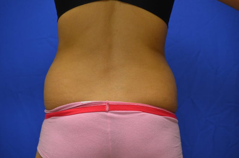 Liposuction Before & After Gallery - Patient 116564 - Image 3