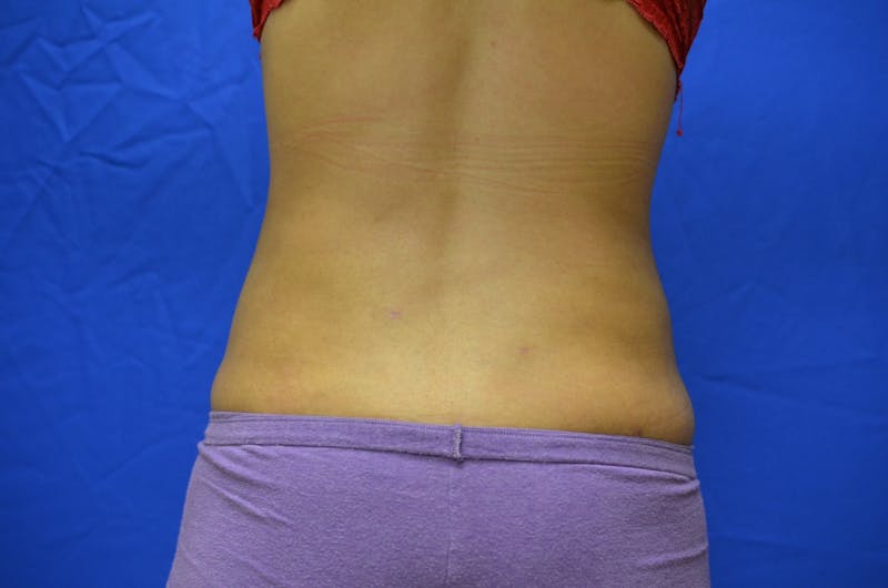 Liposuction Before & After Gallery - Patient 116564 - Image 4