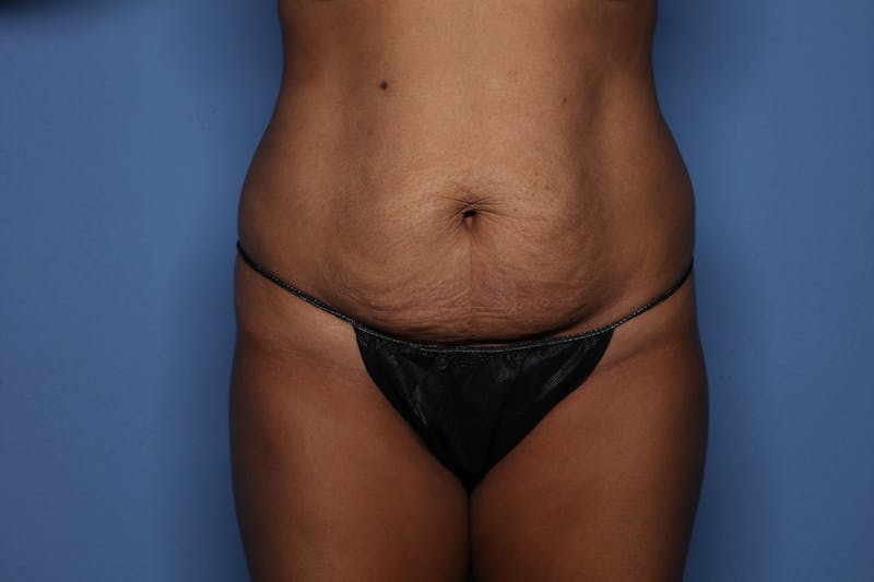 Tummy Tuck Before & After Gallery - Patient 421039 - Image 1