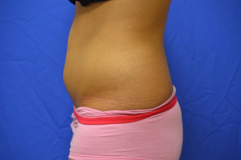 Liposuction Before & After Gallery - Patient 116564 - Image 5
