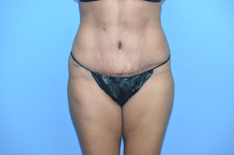 Tummy Tuck Before & After Gallery - Patient 421039 - Image 2