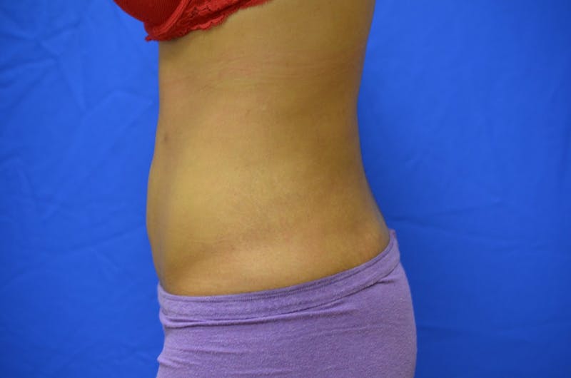 Liposuction Before & After Gallery - Patient 116564 - Image 6