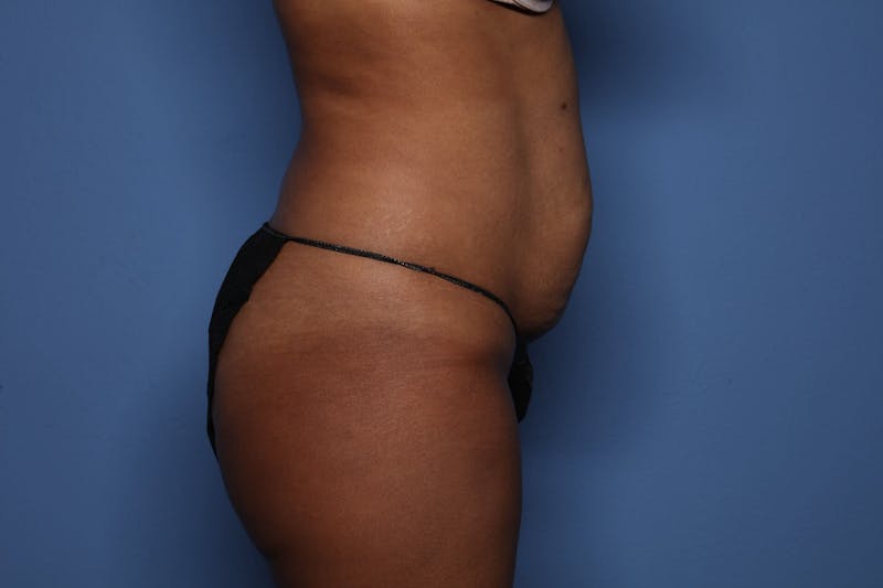 Tummy Tuck Before & After Gallery - Patient 421039 - Image 3