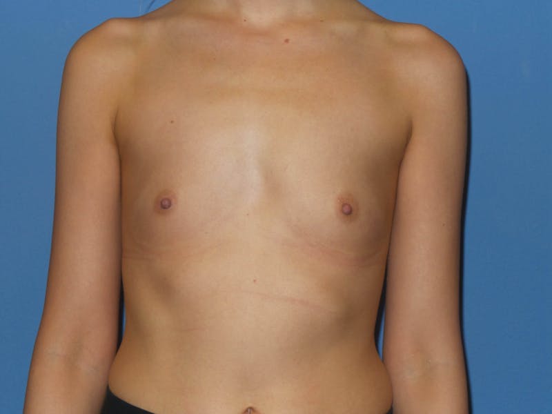 Breast Augmentation Before & After Gallery - Patient 383454 - Image 1