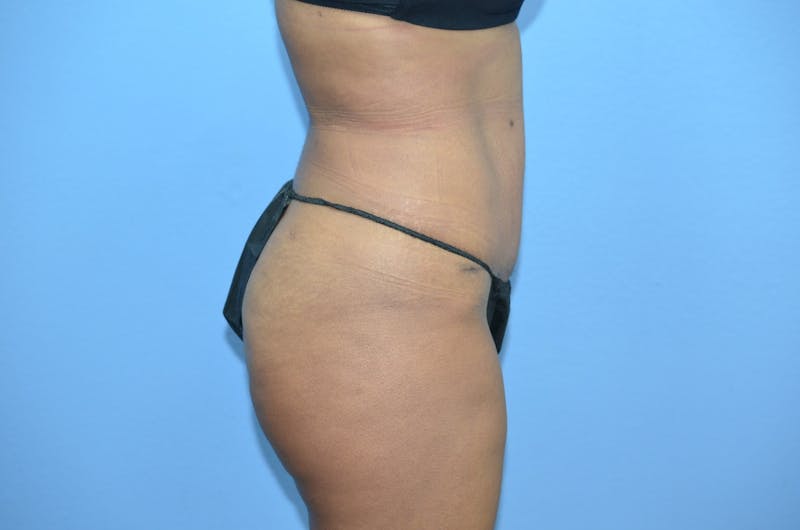 Tummy Tuck Before & After Gallery - Patient 421039 - Image 4