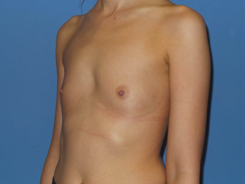 Breast Augmentation Before & After Gallery - Patient 383454 - Image 3
