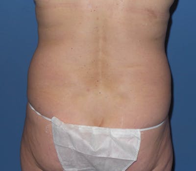 Liposuction Before & After Gallery - Patient 405295 - Image 1