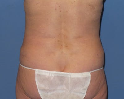 Liposuction Before & After Gallery - Patient 405295 - Image 2