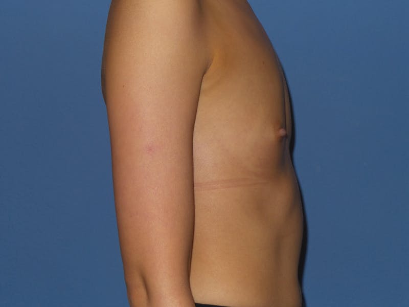 Breast Augmentation Before & After Gallery - Patient 383454 - Image 5