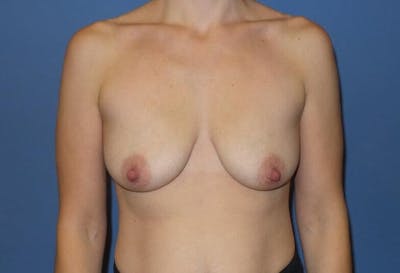 Breast Augmentation + Lift Before & After Gallery - Patient 137870 - Image 1