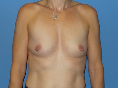Breast Augmentation Before & After Gallery - Patient 412484 - Image 1