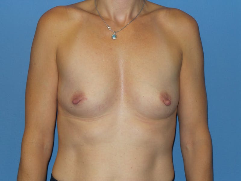 Breast Augmentation Before & After Gallery - Patient 412484 - Image 1