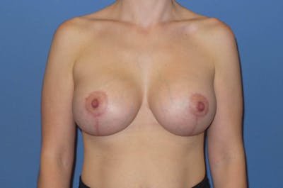 Breast Augmentation + Lift Before & After Gallery - Patient 137870 - Image 2