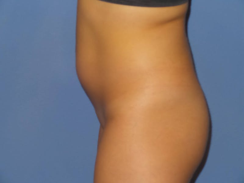 Liposuction Before & After Gallery - Patient 372403 - Image 5