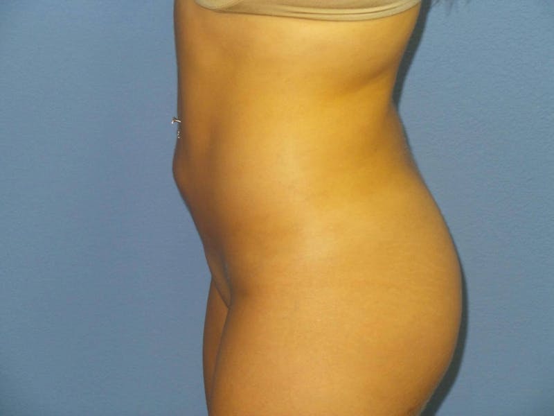Liposuction Before & After Gallery - Patient 372403 - Image 6