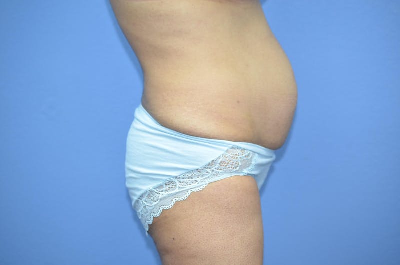 Tummy Tuck Before & After Gallery - Patient 440296 - Image 7