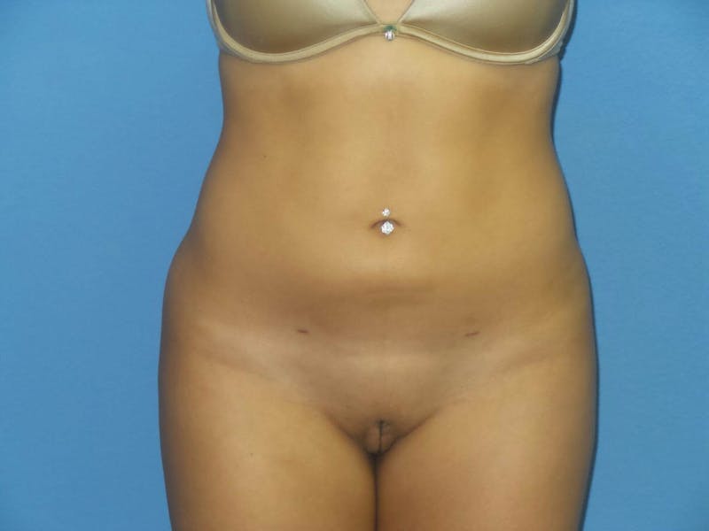 Liposuction Before & After Gallery - Patient 372403 - Image 8