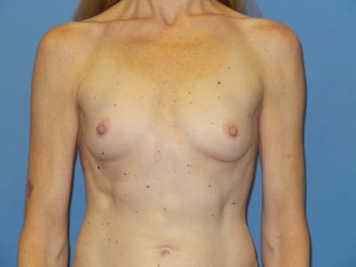 Breast Augmentation Before & After Gallery - Patient 249825 - Image 1