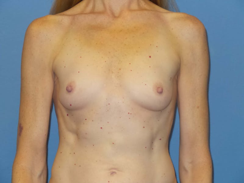 Breast Augmentation Before & After Gallery - Patient 249825 - Image 1