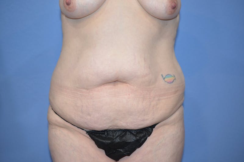 Tummy Tuck Before & After Gallery - Patient 461491 - Image 1