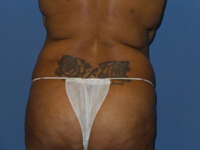 Liposuction Before & After Gallery - Patient 384995 - Image 1