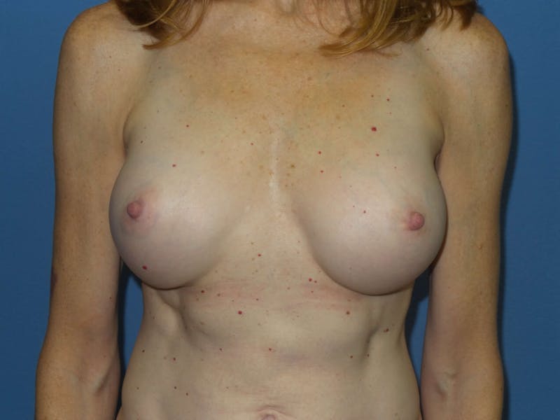 Breast Augmentation Before & After Gallery - Patient 249825 - Image 2