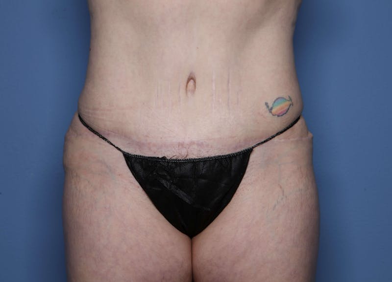 Tummy Tuck Before & After Gallery - Patient 461491 - Image 2