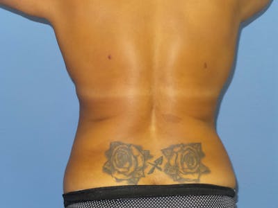 Liposuction Before & After Gallery - Patient 384995 - Image 2