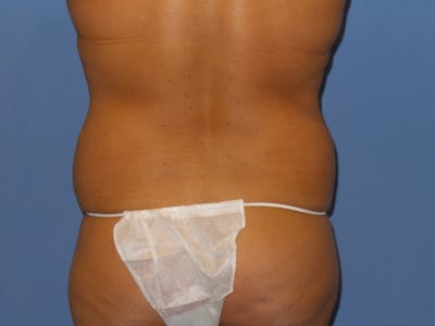 Liposuction Before & After Gallery - Patient 375563 - Image 1