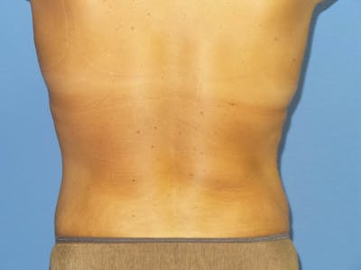 Liposuction Before & After Gallery - Patient 375563 - Image 2