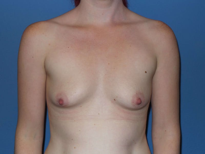 Breast Augmentation Before & After Gallery - Patient 402338 - Image 1
