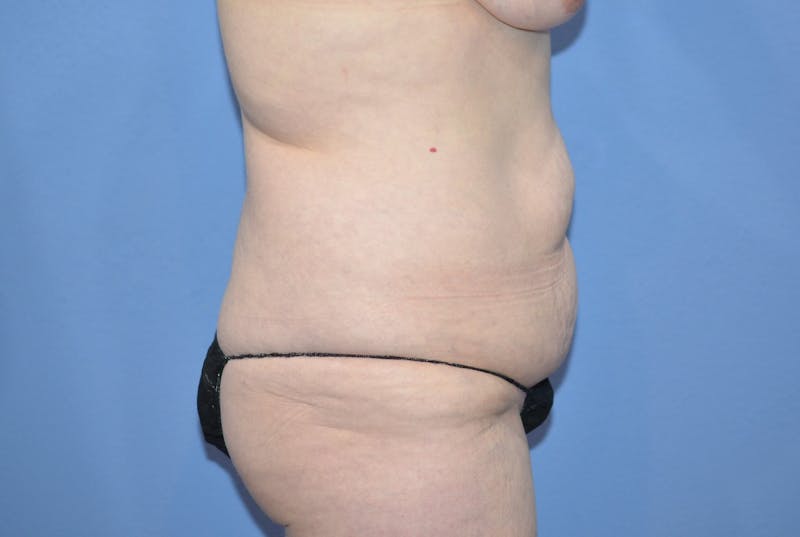 Tummy Tuck Before & After Gallery - Patient 461491 - Image 5