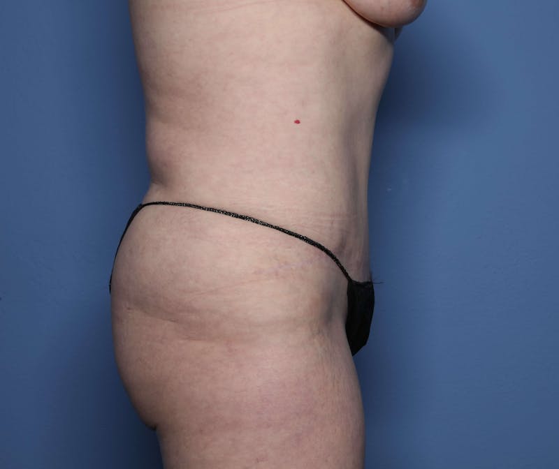 Tummy Tuck Before & After Gallery - Patient 461491 - Image 6