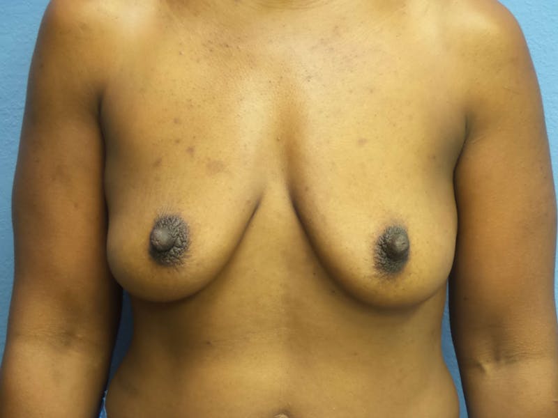 Breast Augmentation Before & After Gallery - Patient 629277 - Image 1