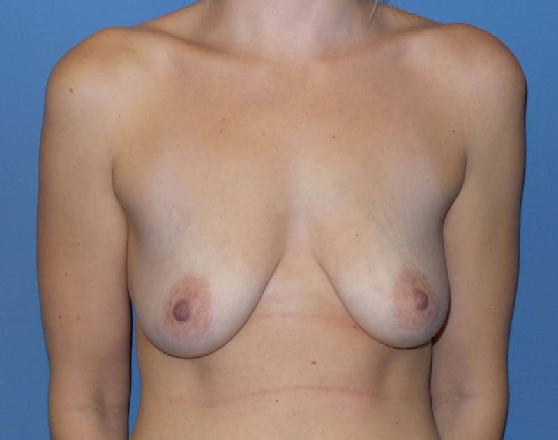 Breast Augmentation + Lift Before & After Gallery - Patient 188583 - Image 1