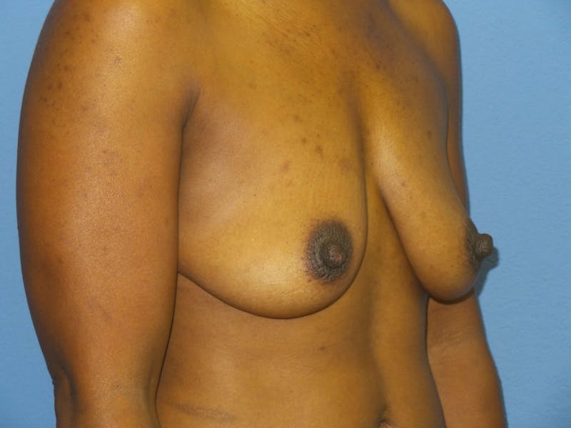 Breast Augmentation Before & After Gallery - Patient 629277 - Image 3