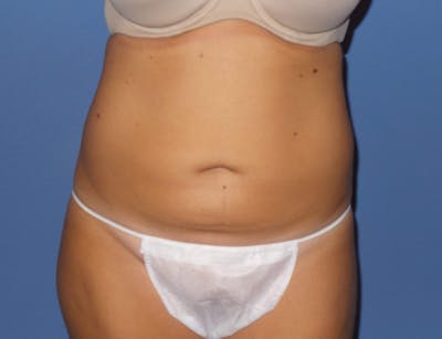Liposuction Before & After Gallery - Patient 242562 - Image 1