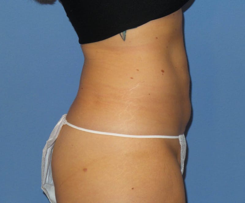 Liposuction Before & After Gallery - Patient 242562 - Image 4