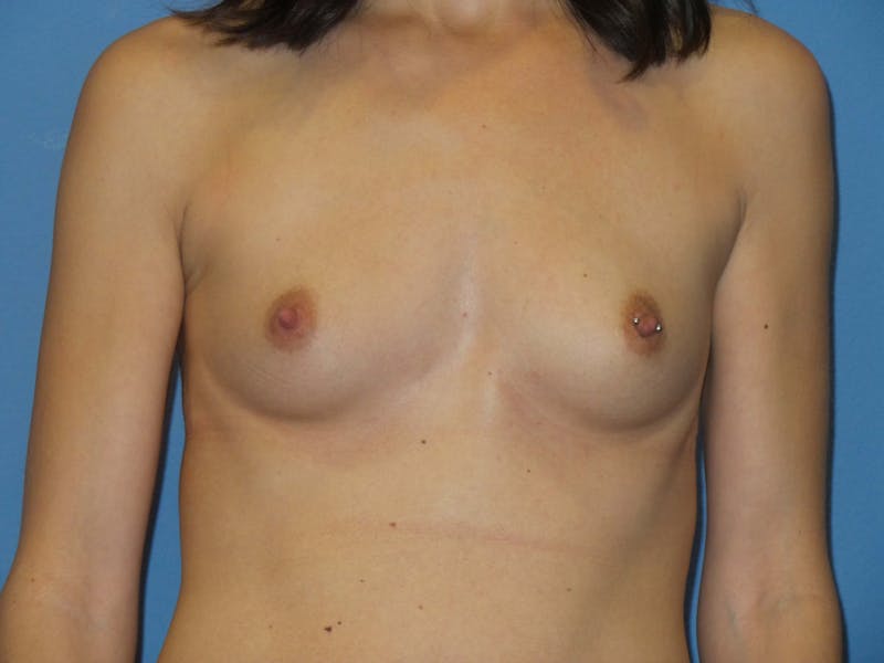 Breast Augmentation Before & After Gallery - Patient 124237 - Image 1