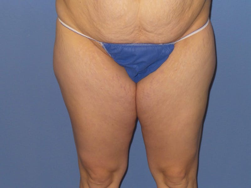 Liposuction Before & After Gallery - Patient 183703 - Image 1