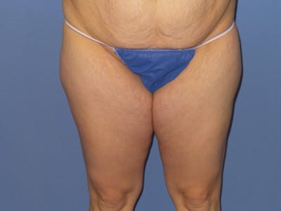 Liposuction Before & After Gallery - Patient 183703 - Image 1