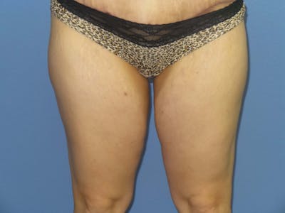 Liposuction Before & After Gallery - Patient 183703 - Image 2
